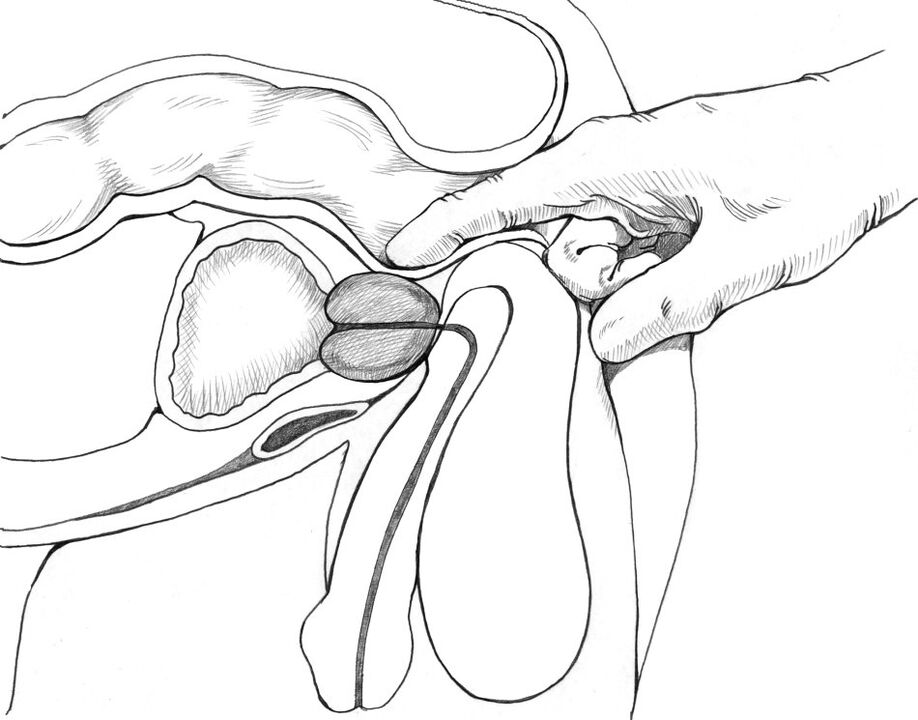 Prostate massage is included in the complex of prostatitis treatment methods.